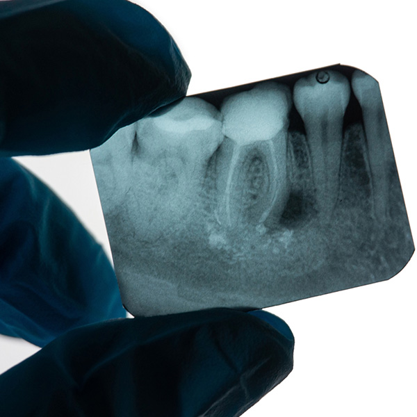 dental x rays