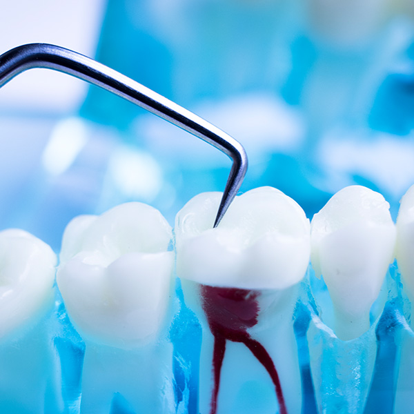 dental implants